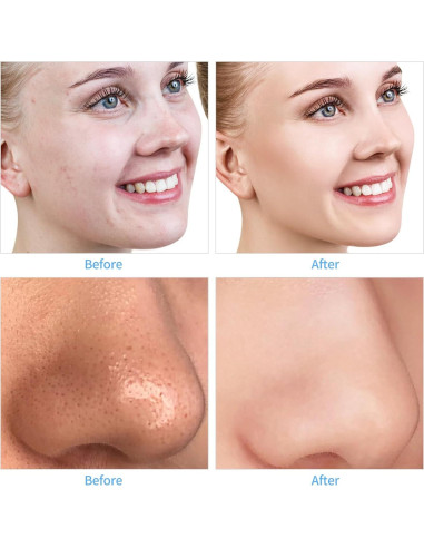 Máquina de Microdermoabrasión Profesional mcwdoit Portátil