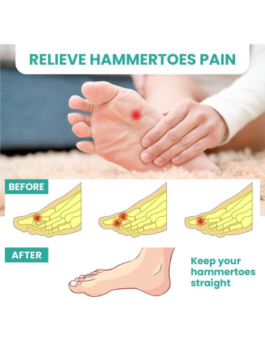 Corrector de Dedos en Martillo Welnove - 8 Piezas Gel Silicona