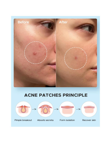Parches para Acné LitBear - Día y Noche, 180 Piezas, 4 Tamaños
