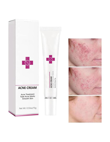 Crema para el Acné Onkessy 15 ml - Control de Aceite y Espinillas