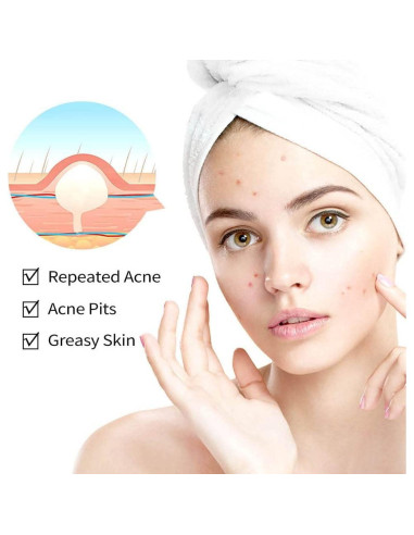 Crema para el Acné Onkessy 15 ml - Control de Aceite y Espinillas