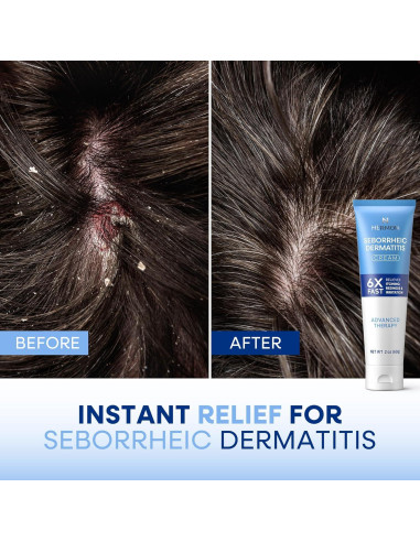Crema Antipicazón Hermon para Dermatitis Seborreica 82g