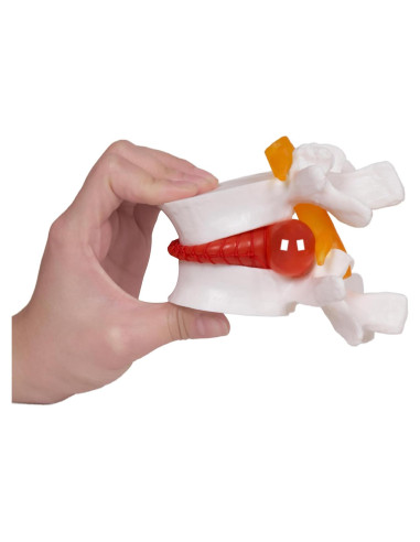 Modelo de Herniación de Disco Lumbar NLShan 1.5x Real