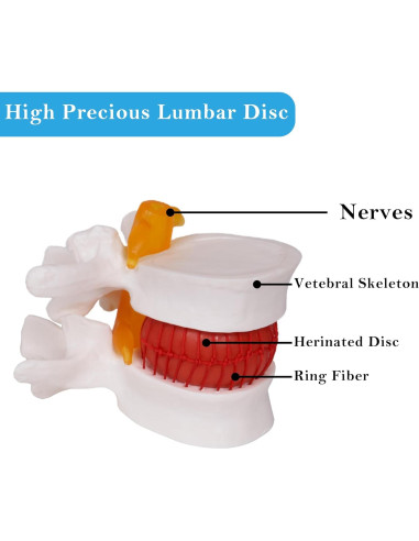 Modelo de Herniación de Disco Lumbar NLShan 1.5x Real