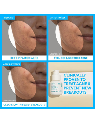 Suero Facial Innisfree para Acné con Retinol y Salicílico