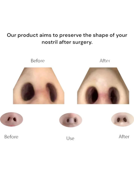 Retenedor Nasal Premium Nanovita para Rinoplastia - 2 Tamaños Retenedor Nasal Premium Nanovita para Rinoplastia - 2 Tamaños