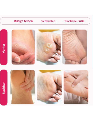 Mascarilla Exfoliante para Pies Summer Foot - 1 Par - Extractos de Pepino y Urea