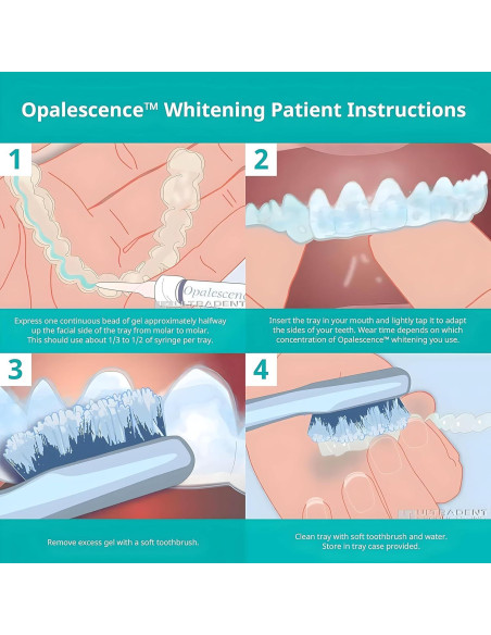 Kit Blanqueamiento Dental Opalescence 20% Ultradent 4 Jeringas Kit Blanqueamiento Dental Opalescence 20% Ultradent 4 Jeringas