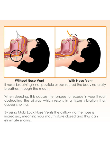 Dilator Nasal Anti-Ronquidos Mobi Lock - Paquete de 8 Tamaños Dilator Nasal Anti-Ronquidos Mobi Lock - Paquete de 8 Tamaños