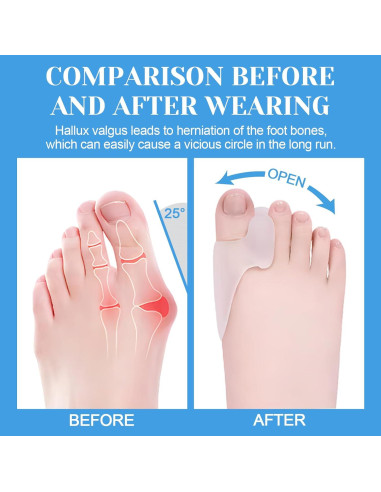 Paquete de 6 Protectores de Gel para Juanetes Nailgelicer