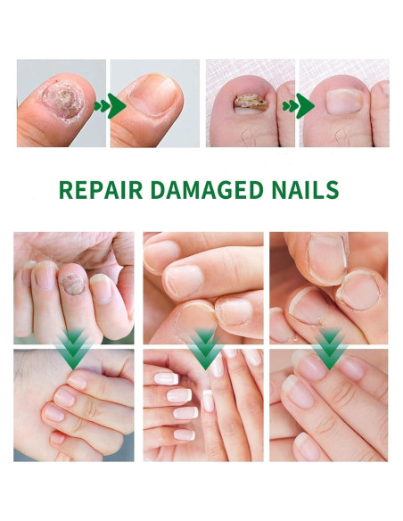 Suero de Crecimiento de Uñas Sytani 2PCS Esencia de Jengibre Suero de Crecimiento de Uñas Sytani 2PCS Esencia de Jengibre