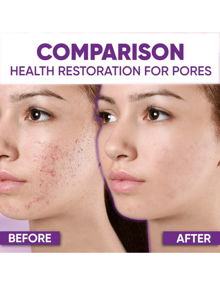 Crema Tratamiento Acné AOBBIY Ácido Azelaico 10% 28g Crema Tratamiento Acné AOBBIY Ácido Azelaico 10% 28g